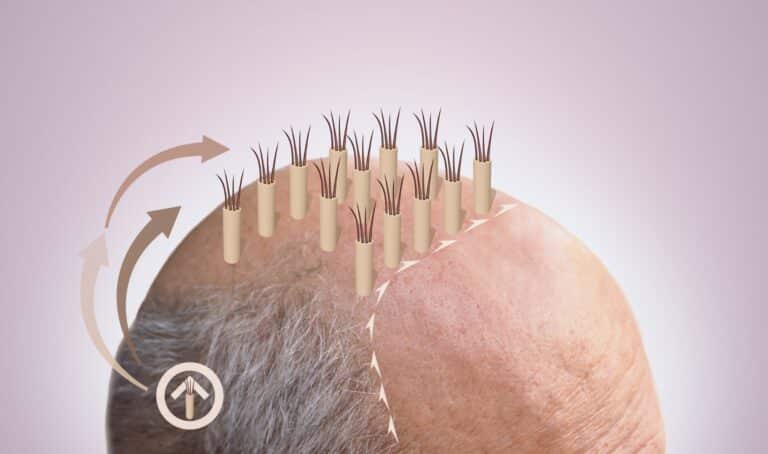 FUE Hair Transplant